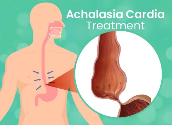 Achalasia Treatment at Home
