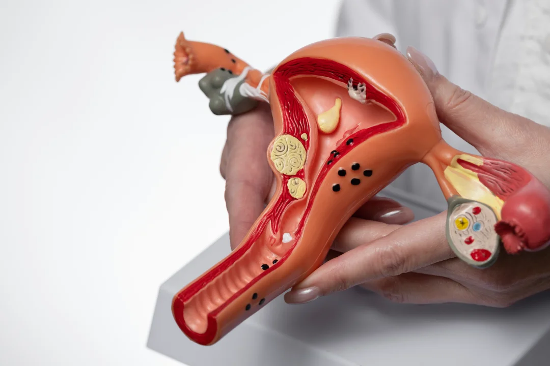 Endometriosis Treatment in dubai