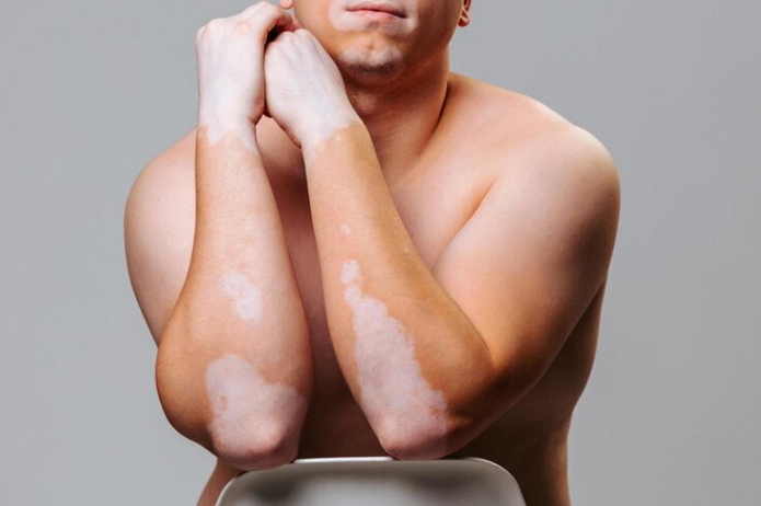 vitiligo hand