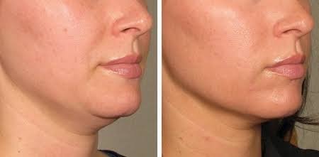 Ultherapy Dubai